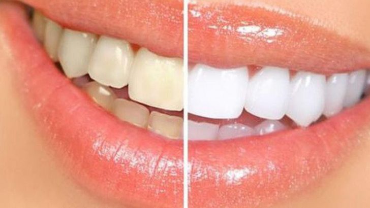 Dişlerinizi Kolay Bir Şekilde Beyazlatmak İçin Doğal Tarifler
